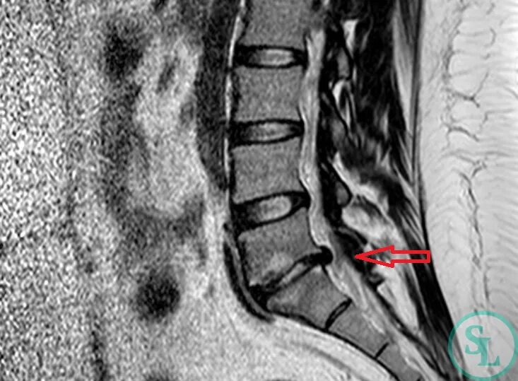 Грыжа диска l5 s1 что это. L5-s1 межпозвонковая грыжа. Межпозвонковые диски l5-s1. Секвестрированная грыжа l5-s1. Грыжа l5-s1.