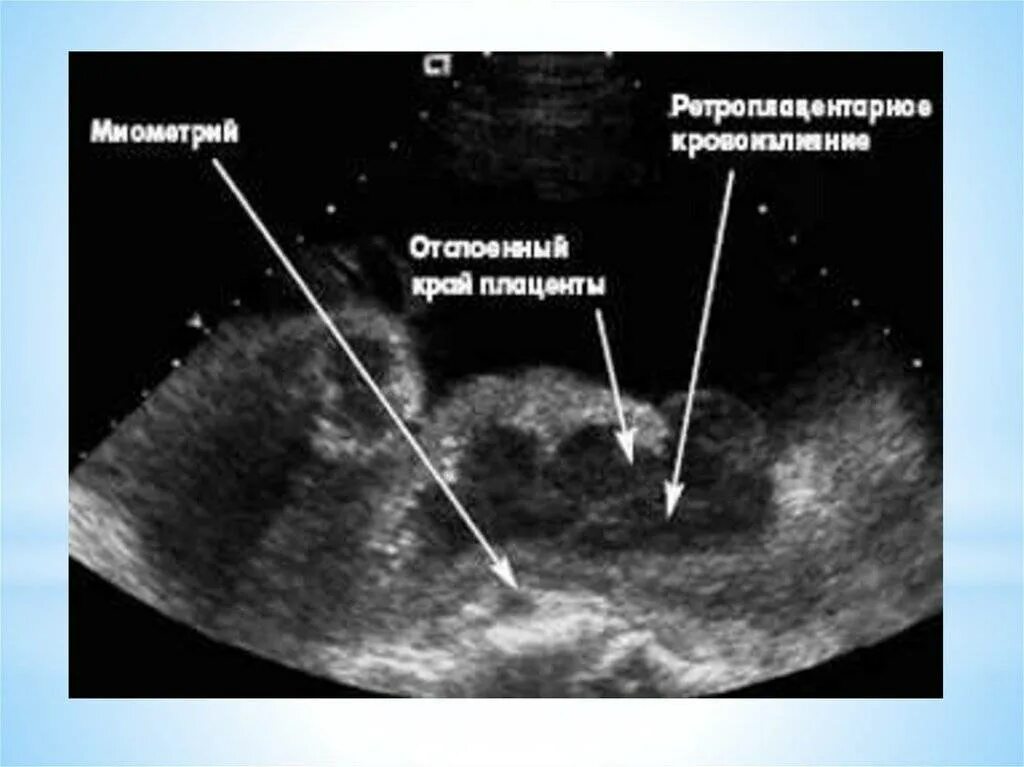 Отслойка хориона на ранних сроках. Преждевременная отслойка нормально расположенной плаценты УЗИ. Отслойка нормально расположенной плаценты УЗИ. Преждевременная отслойка плаценты УЗИ. Ультразвуковые признаки отслойки плаценты.