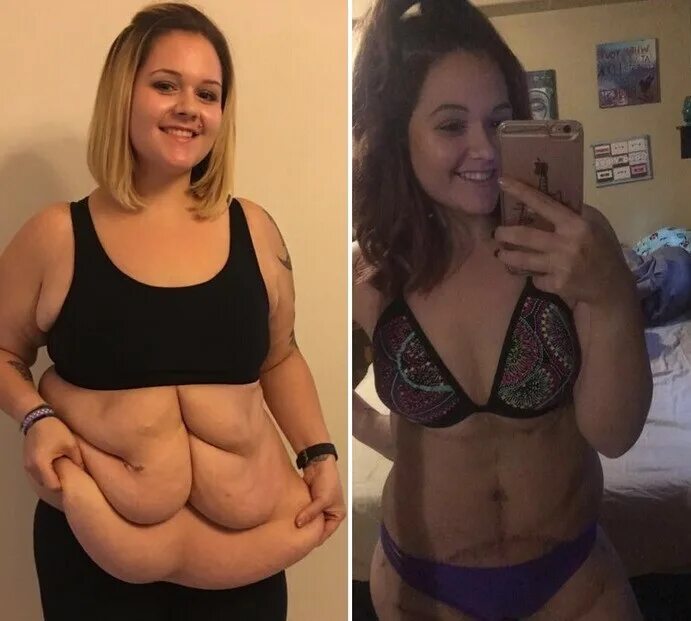 Кожа похудевшего. Кожа похудевшего. Обвисшая кожа после похудения. Лишняя кожа после похудения. Сушка 60 кг.