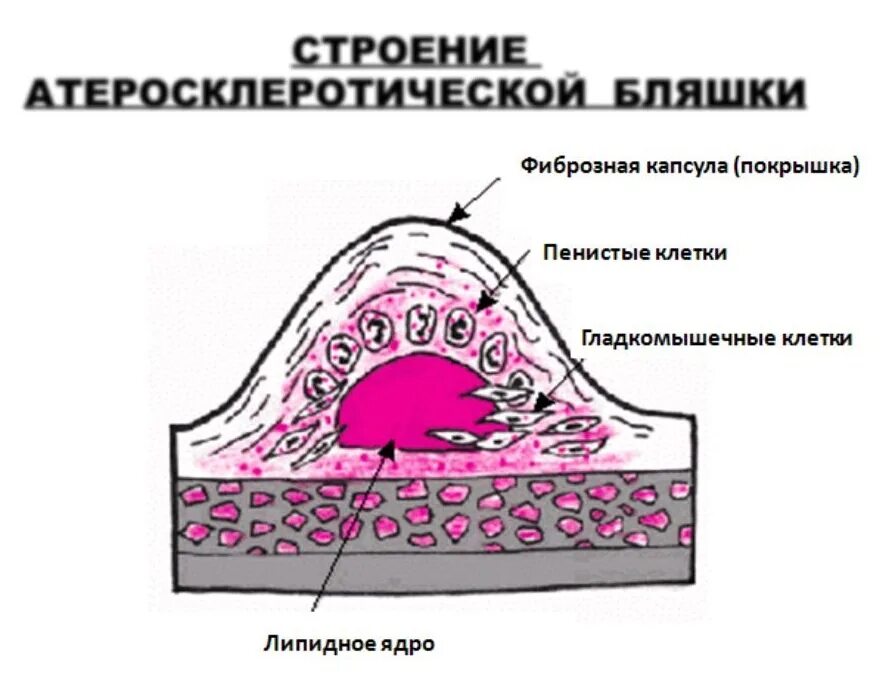 Пенистое содержимое. Атеросклеротическая и атероматозная бляшка. Фиброзная бляшка из чего состоит. Из чего состоит атеросклеротическая бляшка патанатомия. Атеросклероз строение бляшки.