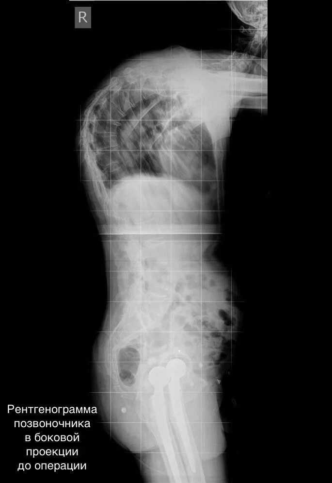 Рентгенография позвоночника в 2 х проекциях. Болезнь Бехтерева рентгенограммы позвоночника. Болезнь Бехтерева рентген таза. Рентген снимок позвоночника болезнь Бехтерева. Болезнь Бехтерева на рентгенограмме.