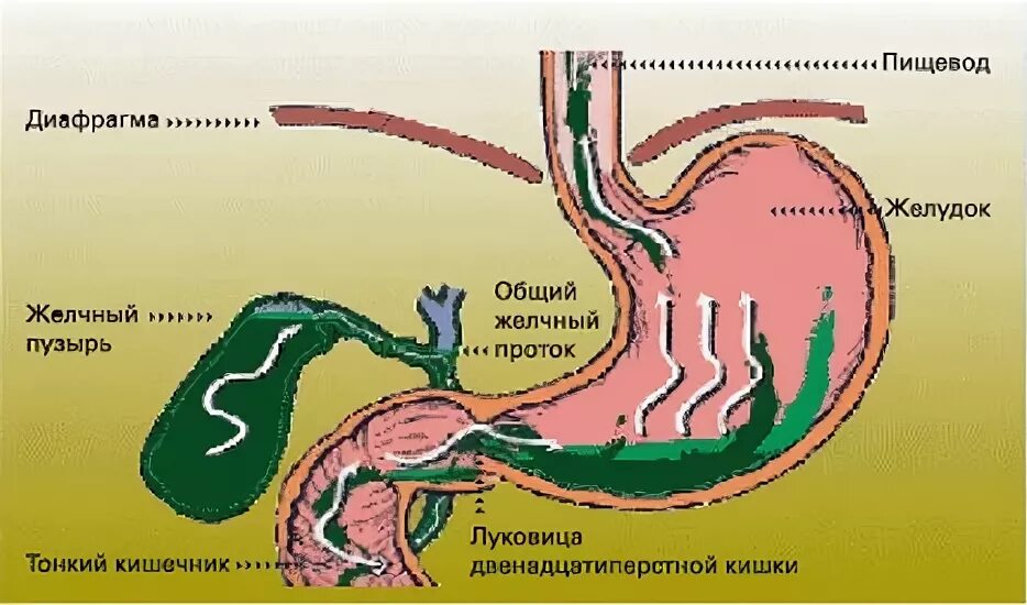 Желчь попадает в кишечник. Билиарный желчный рефлюкс. Желчная кислота в желудке.