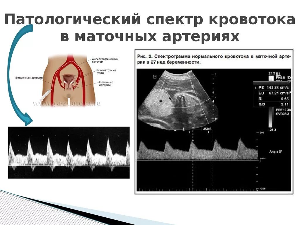 Индекс резистентности артерий. Нарушение кровотока в маточных артериях при беременности. Кровоток в маточных артериях при беременности. Нарушение кровотока в маточной артерии. Кроанток в матосных артеричх.