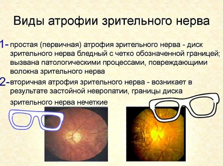 Атрофия зрительного нерва классификация. Врожденная атрофия зрительного нерва. Глаукоматозная атрофия зрительного нерва. Первичная атрофия зрительного нерва.