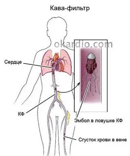 Тромб фильтр