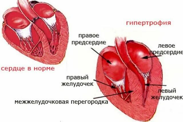 Гипертрофия левого предсердия и правого желудочка. Гипертрофия желудочка сердца. Гипертрофия левого предсердия желудка. Гипертрофия правого и левого желудочка. Гипертрофия левого предсердия левого желудочка