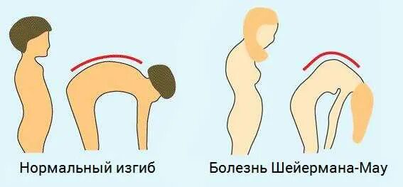 Болезнь шейермана мау что это такое. Кифоз болезнь Шейермана-МАУ. - Гиперкифоз (болезнь Шейермана-МАУ). Искривление позвоночника синдром Шейермана МАУ. Искривление позвоночника Шерман МАУ.