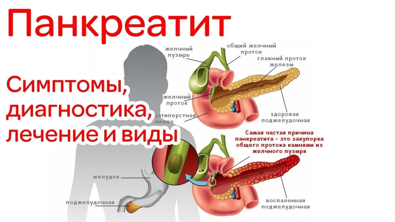 Поджелудочной железы симптомы проявление болезни. Панкреатит заболевание поджелудочной железы симптомы. Симптомы поражения поджелудочной железы. Симптомы болезни поджелудочной железы у женщин.