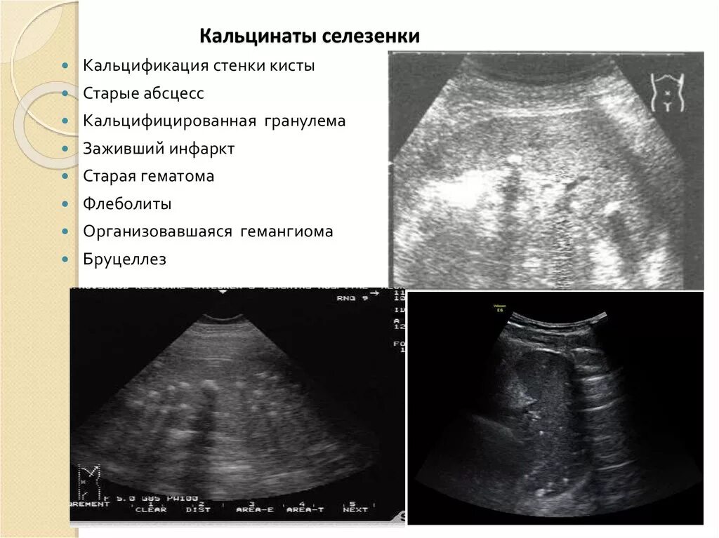 Кальцинаты селезенки. Микрокальцинаты в печени на УЗИ. Микрокальцинаты селезенки на УЗИ. Кальцинат в селезенке на УЗИ.