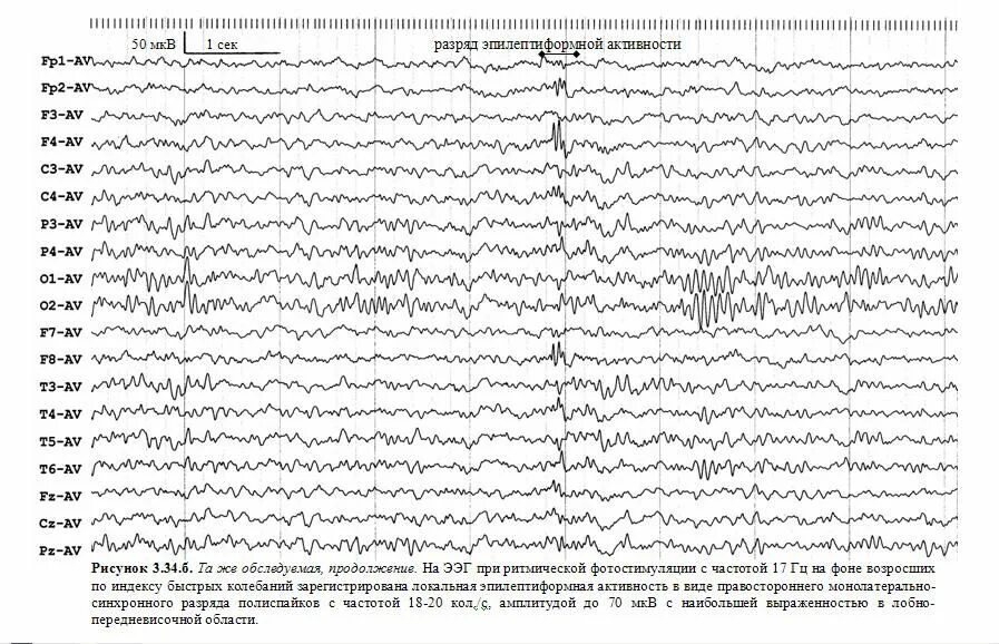 Эпилептиформная активность на ээг у ребенка. Эпилептические паттерны на ЭЭГ. Региональная эпилептиформная активность ЭЭГ. Эпилептиформные феномены на ЭЭГ что это. Полиспайки на ЭЭГ.