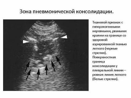 Консолидация легочной ткани на кт