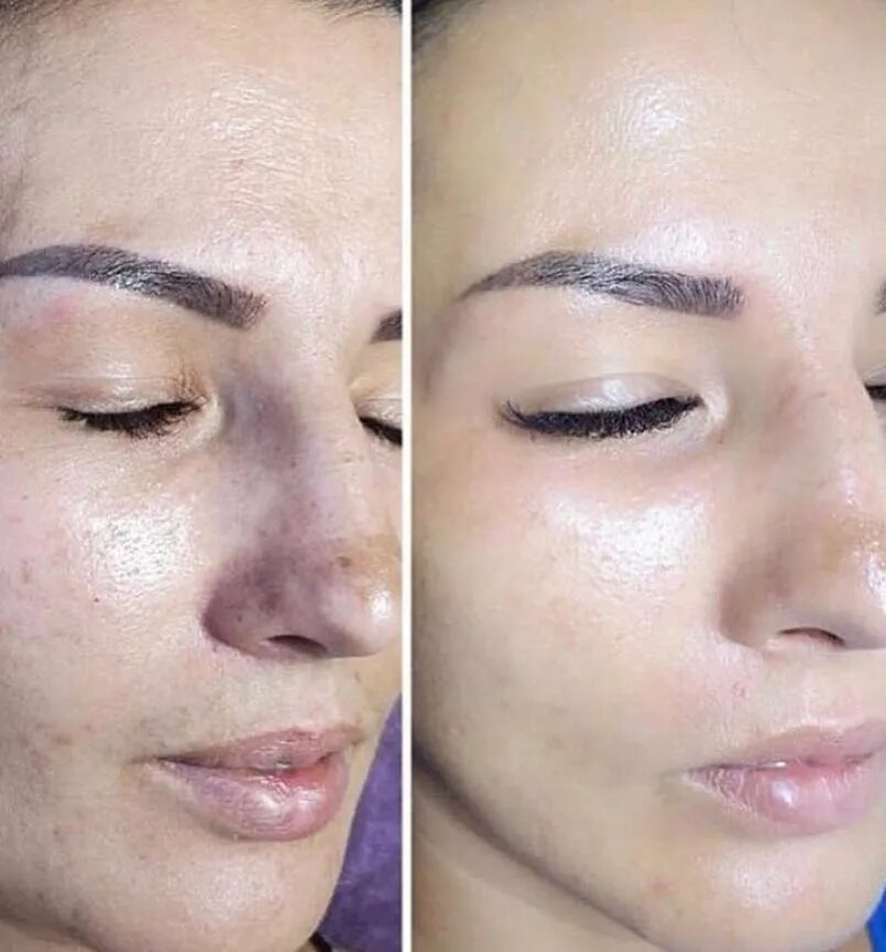 микронидлинг вв глоу. процедура glow для лица. перманент лица тональный крем. эффект бб глоу. процедура glow для лица.