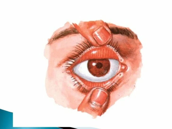 Конъюнктивальный мешок глаза. Верхний конъюнктивальный мешок анатомия. Тарзальная конъюнктива. Строение глаза человека конъюнктивальный мешок.