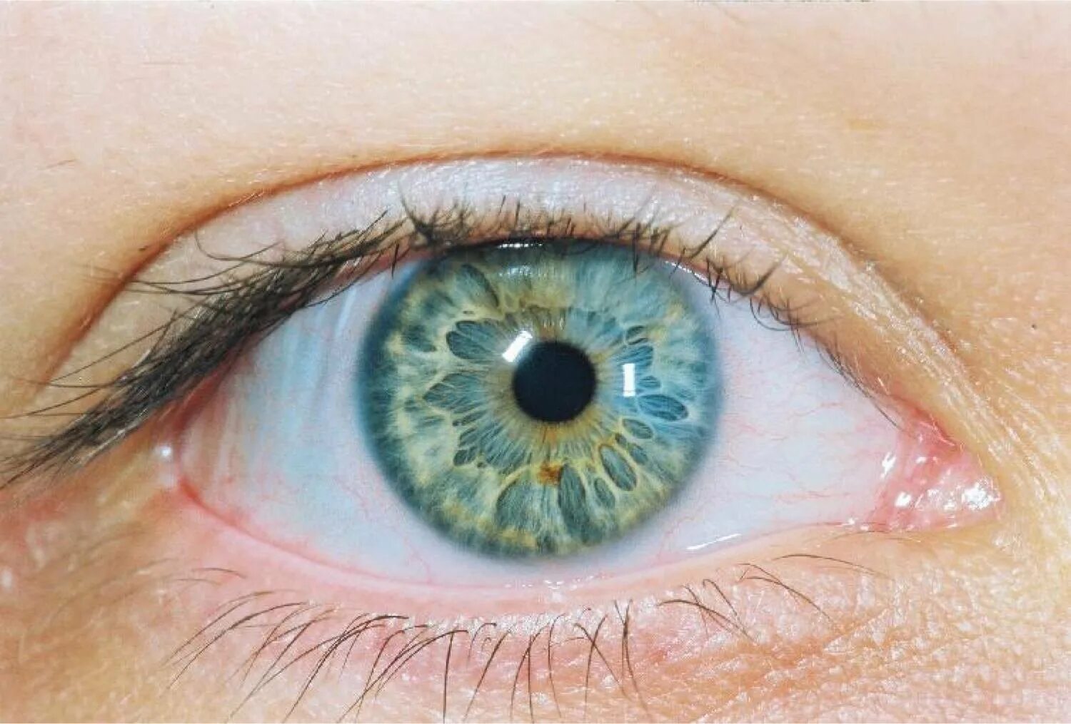 Один глаз серый другой. Центральная гетерохромия серый Карий. Гетерохромия Радужки глаз. Центральная гетерохромия карих глаз. Центральная гетерохромия серых глаз.