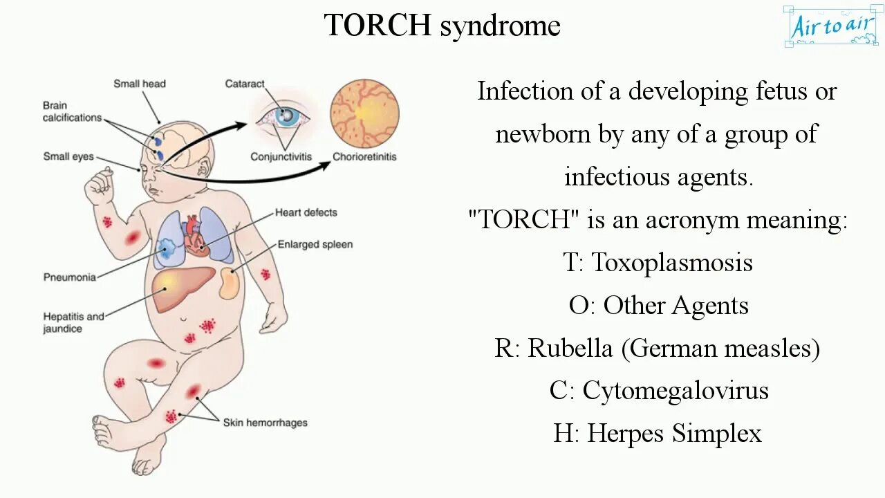 Torch инфекции что это такое. Torch синдром. torch инфекции у новорожденных. торч синдром у новорожденных клинические. torch синдром у новорожденных.