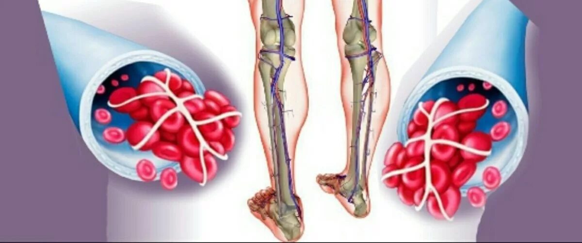 Илеофеморальный венозный тромбоз. Тромбоз вен нижних конечностей. Тромбоз глубоких вен нижних конечностей этиология. Много тромбов