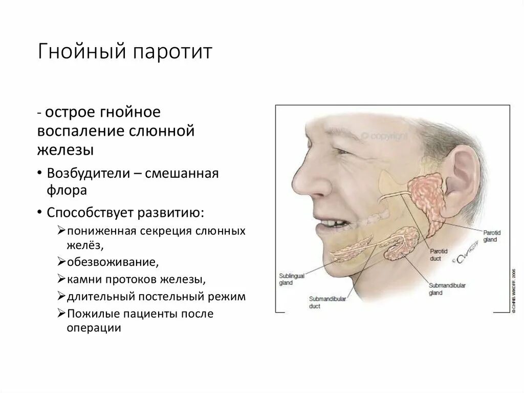 Увеличение околоушной железы. Паротит слюнной железы. Разрезы при Гнойном паротите. Воспаление слюнной железы паротит.