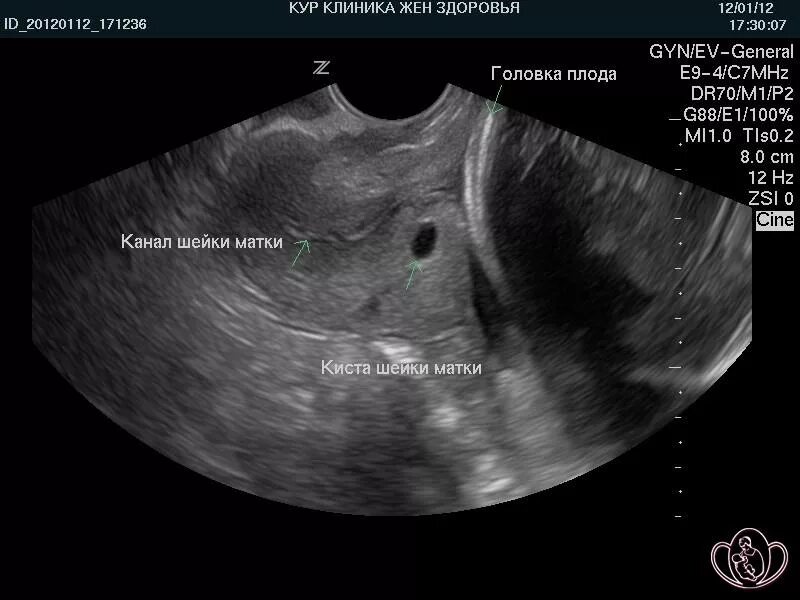 Кисты шейки матки на УЗИ 5 мм. УЗИ матки на УЗИ. Образования в шейке матки на УЗИ. Беременность шейка 3