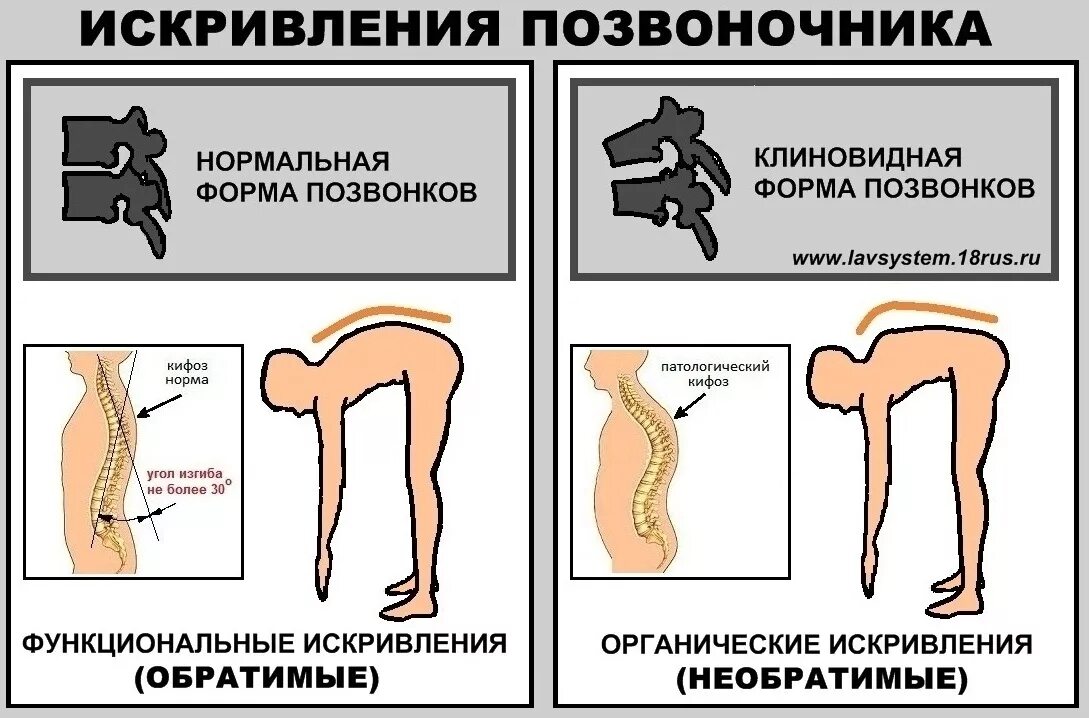 Форма позвоночника. Нормальная кривизна позвоночника. Нормальный изгиб спины. Нормальное положение позвоночника