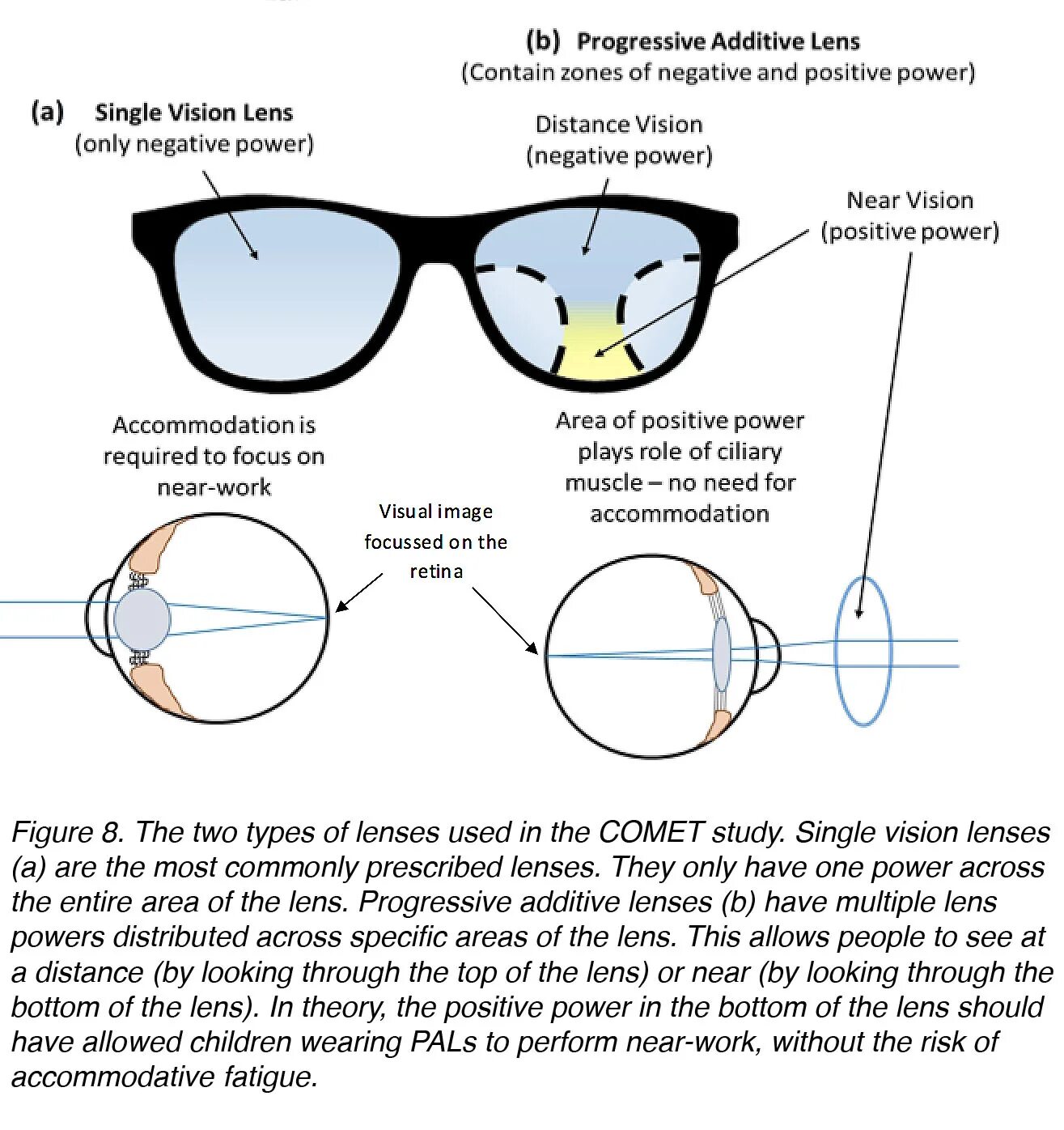 Single vision. Types of Lenses. Optical scheme for the study of myopia. Zeiss myopia Management Lens. Сравнительная характеристика Control myopia.