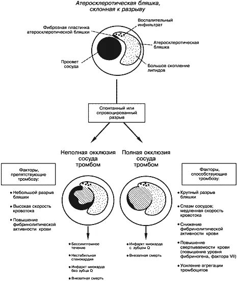 Схема строения атеросклеротической бляшки. Схема строения атеросклеротической бляшки патанатомия. Разрыв атеросклеротической бляшки патогенез. Нестабильная атеросклеротическая бляшка УЗИ.