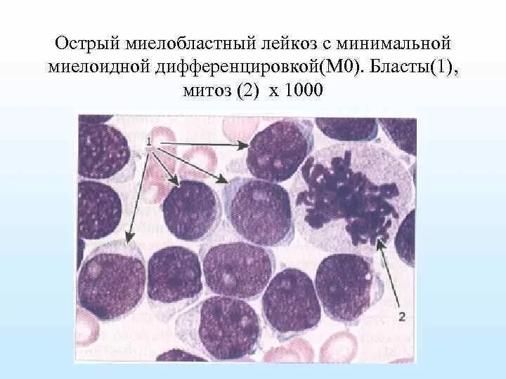 Хронический миелобластный лейкоз гистология. Острый миелолейкоз гистология. Острый миелобластный лейкоз гистология. Хронический миелолейкоз гистология.