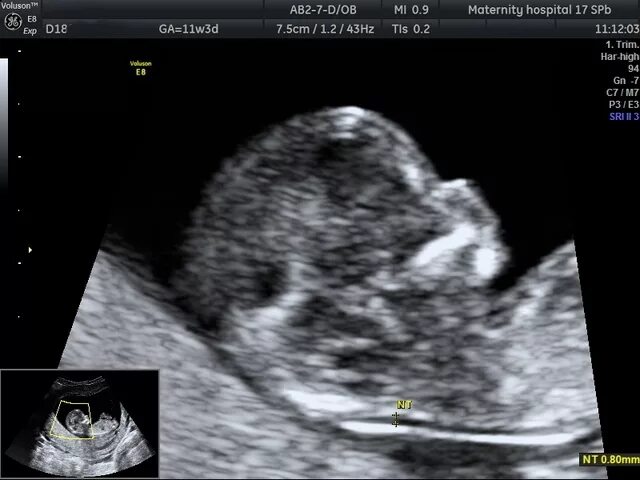 скрининг в областной больнице на луначарского. 17 роддом скрининг. скрининг 1 триместра 3 роддом. 17 роддом скрининг. 17 роддом скрининг.