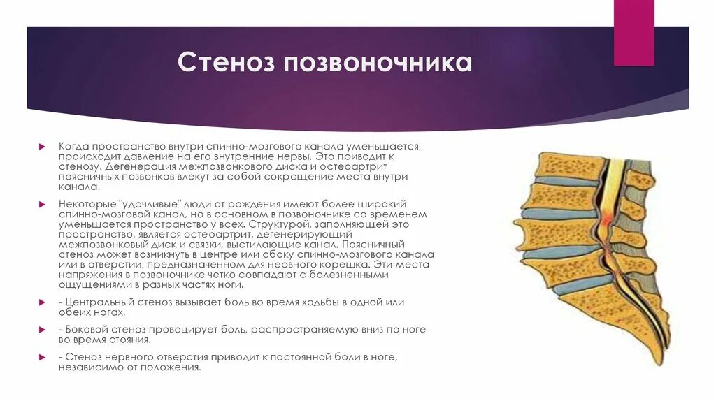 Крестцовый стеноз. Относительный Сагиттальный стеноз позвоночного канала с5-с7. Сужение спинномозгового канала l5s1. Относительный Сагиттальный стеноз позвоночного канала на уровне с5-с6. Степени сужения позвоночного канала кт.