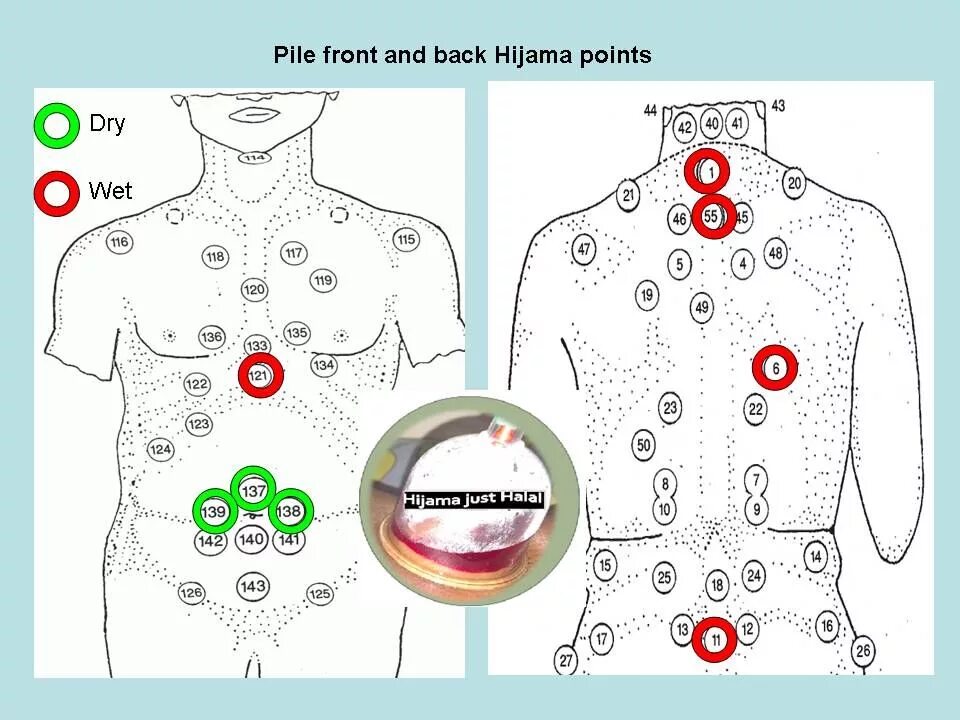 Банки на печень. Схема хиджама точки. Хиджама кровопускание схема атлас точек. Хиджама кровопускание схема точки.