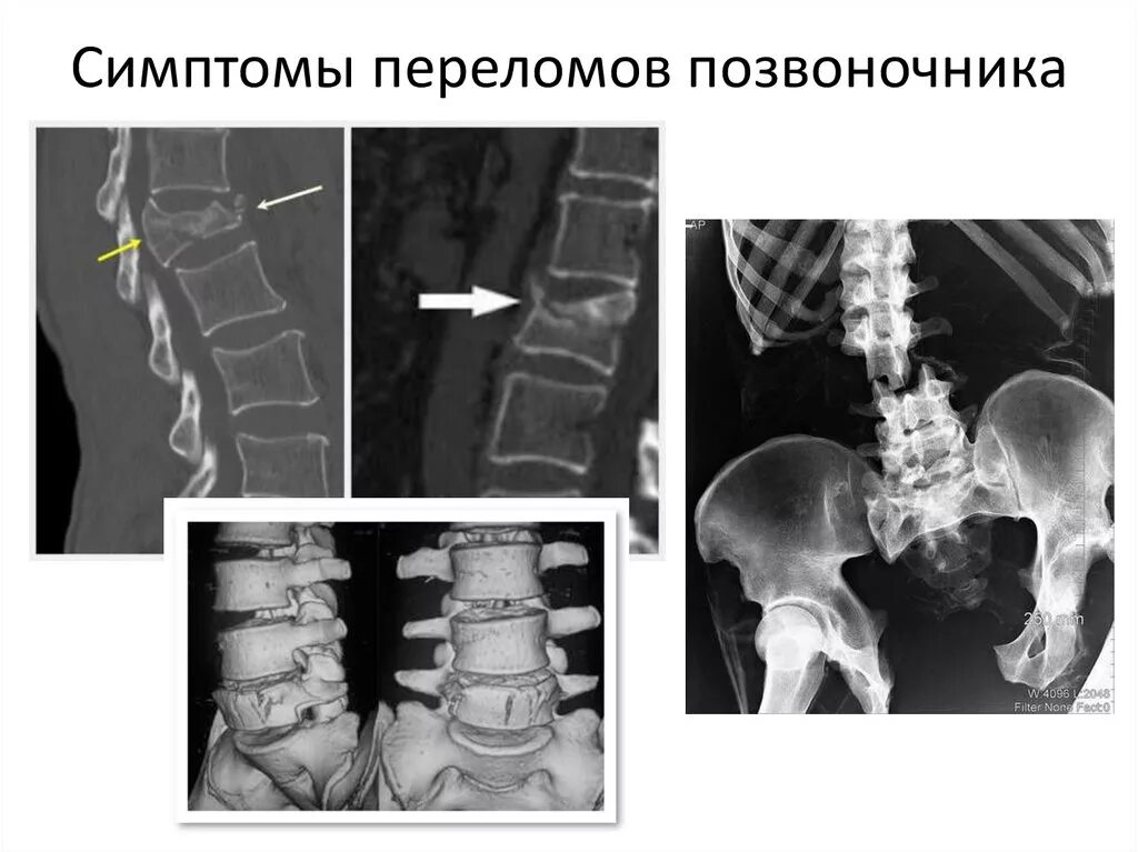 Повреждения позвоночника переломы. Перелом поясничного отдела позвоночника. Компрессионный перелом позвоночника симптомы рентген. Компрессионный перелом позвоночника рентген признаки. Флексионный перелом позвоночника.