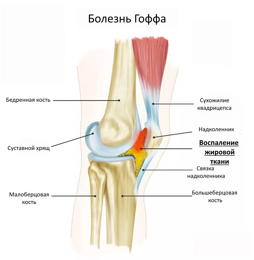 Повреждение клетчатки Гоффа. Жировое тело коленного сустава анатомия. Тело Гоффа коленного сустава. Болезнь Гоффа Гоффа коленного сустава. Коленный сустав производители