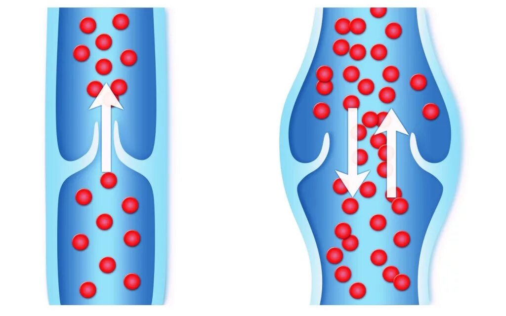 Венозный застой лечение. Варикозное расширение вен нижних конечностей.