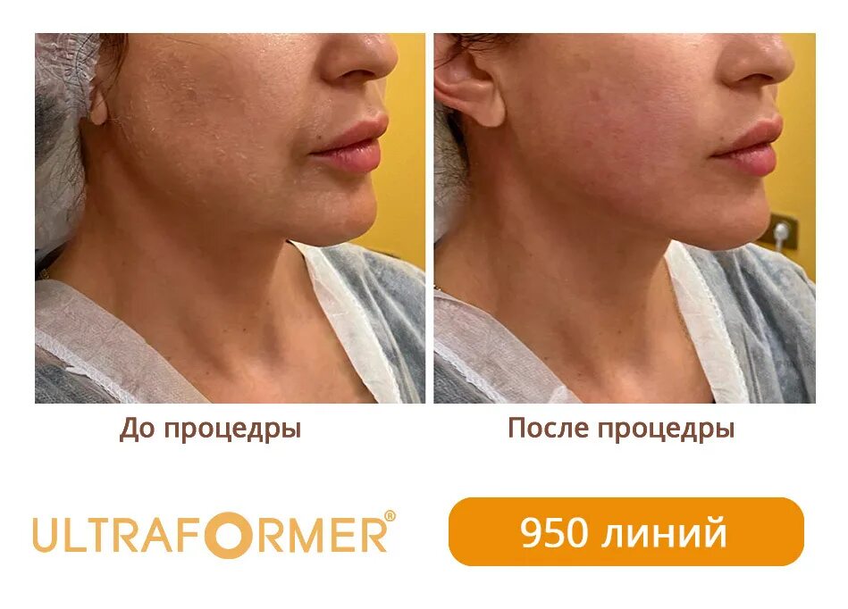 Смас лифтинг ультраформер эффект. Ультраформер отзывы фото. Smas лифтинг ultraformer. Ультраформер лифтинг. Смас лифтинг ultraformer 3.