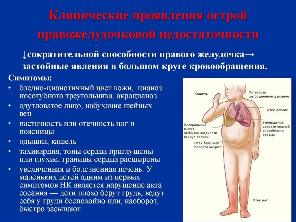 Сердечная недостаточность у детей клинические. Признаки правожелудочковой недостаточности. Ожирение и бронхиальная астма. Клинические проявления правожелудочковой недостаточности. Бронхиальная астма при ожирении.