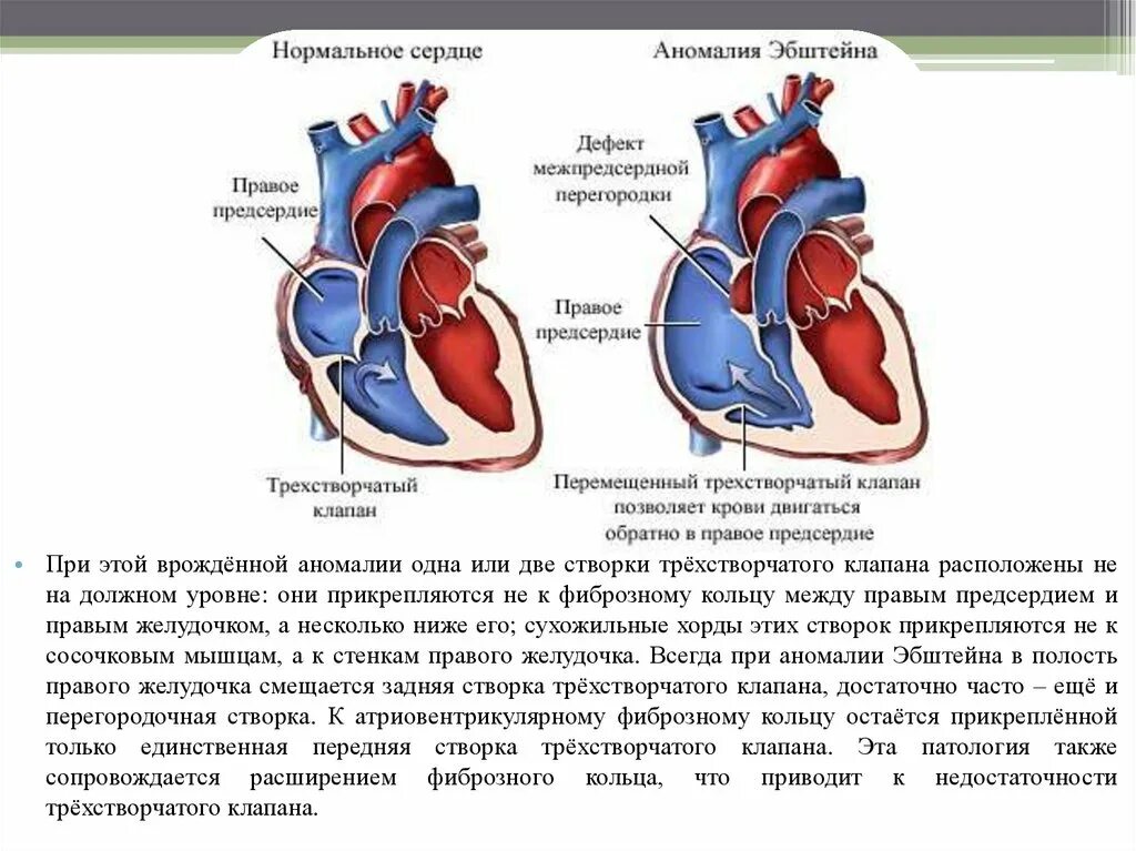 Между правыми предсердием и желудочком находится клапан. Аномалия Эбштейна сердца. Аномалия Эбштейна сердца врожденный. Створки трехстворчатого клапана анатомия. Створки трикуспидального клапана анатомия.