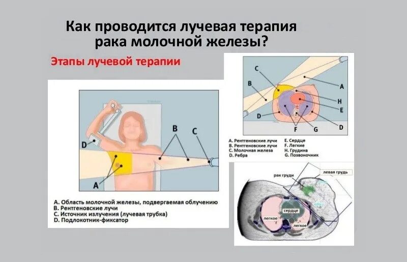 Лучевая терапия после операции сколько сеансов. Радиотерапия в онкологии после операции. Кт топометрия молочной железы перед лучевой терапией. Лучевая терапия РМЖ последствия. РМЖ лучевая терапия после операции.