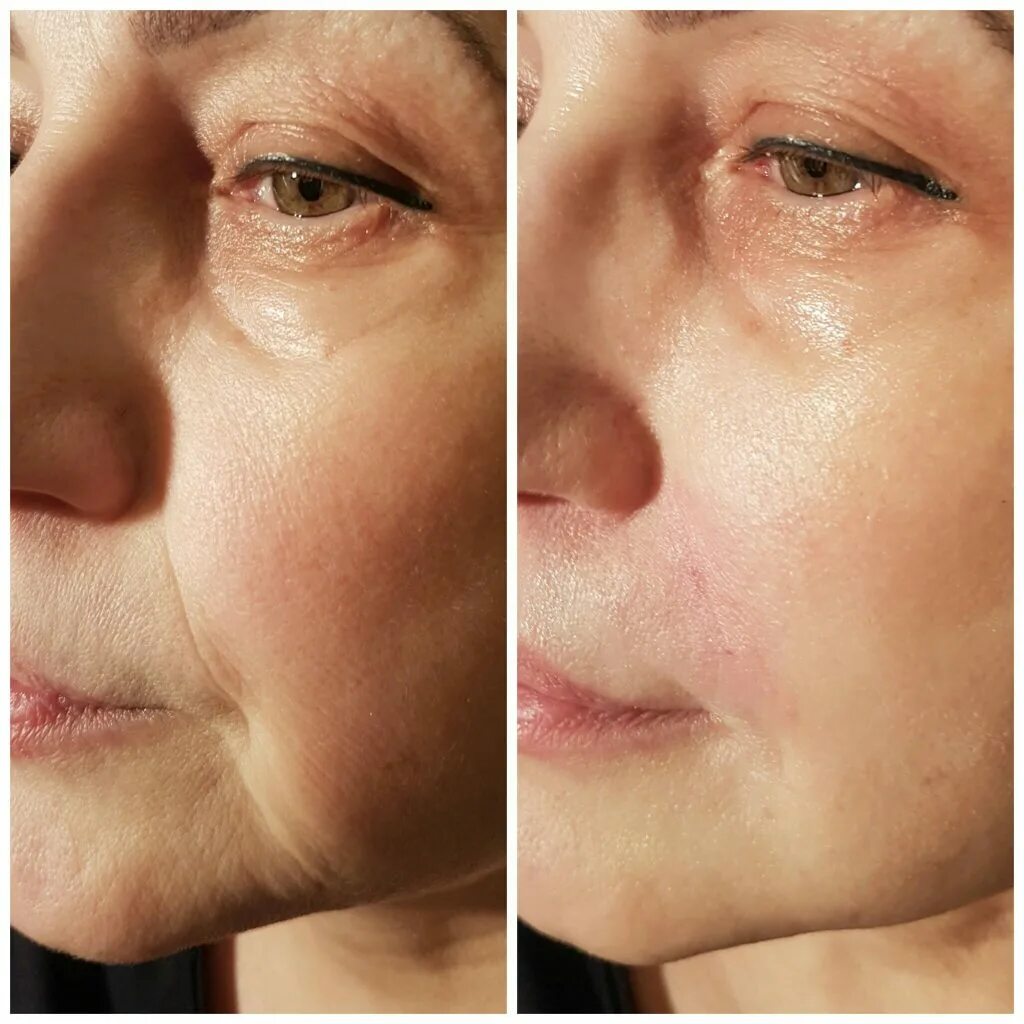 что нельзя делать после носогубных складок