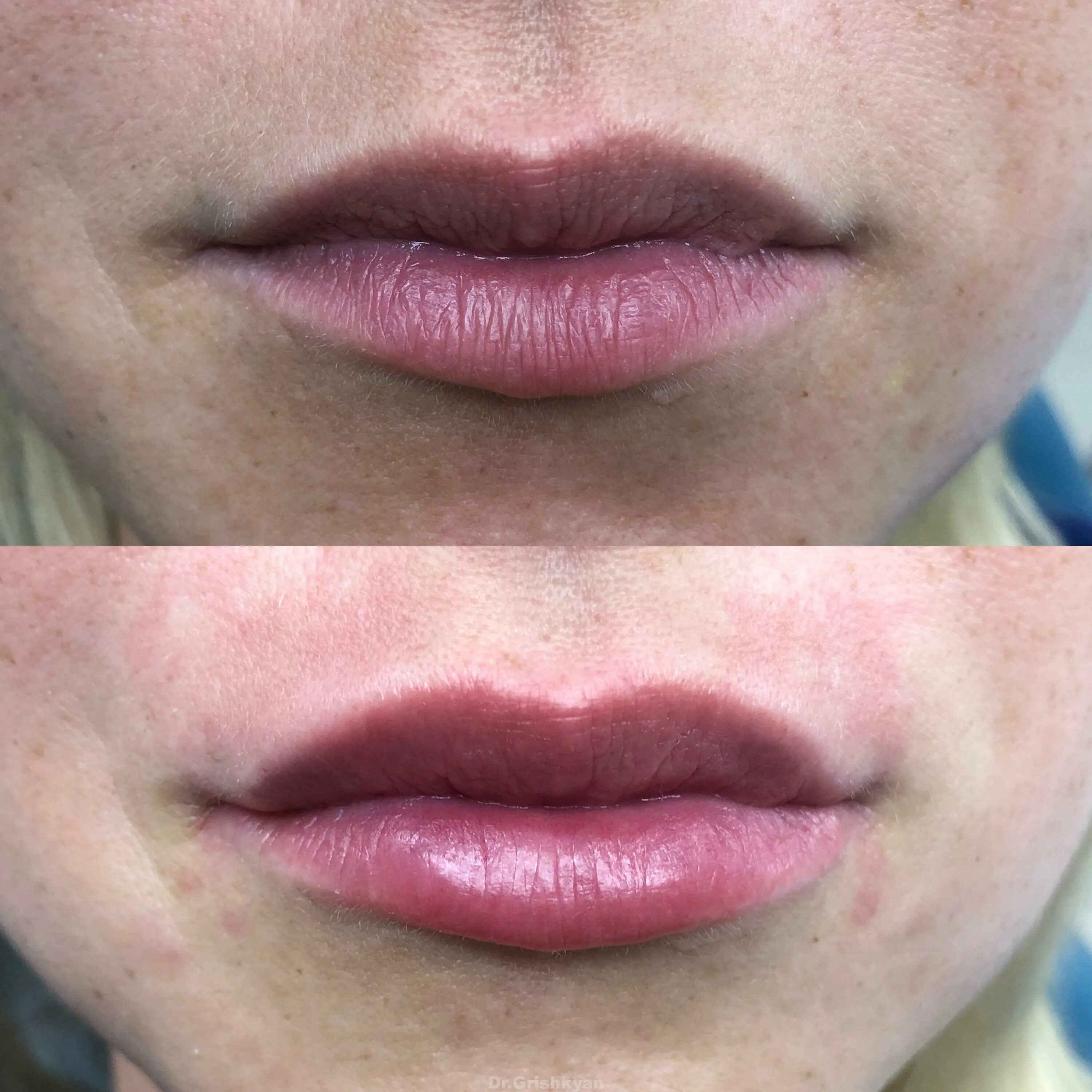 Увлажнение губ до и после. Увлажнение губ гиалуроновой кислотой. Исправление асимметрии губ. Увлажненные губы до и после.