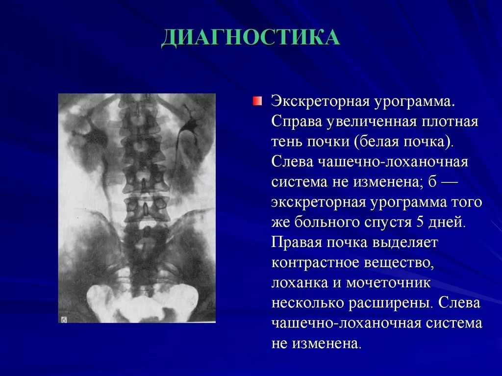 Экскреторная урограмма. Расширение ЧЛС левой почки. Расширение чашечно-лоханочной системы. Правая почка меньше левой