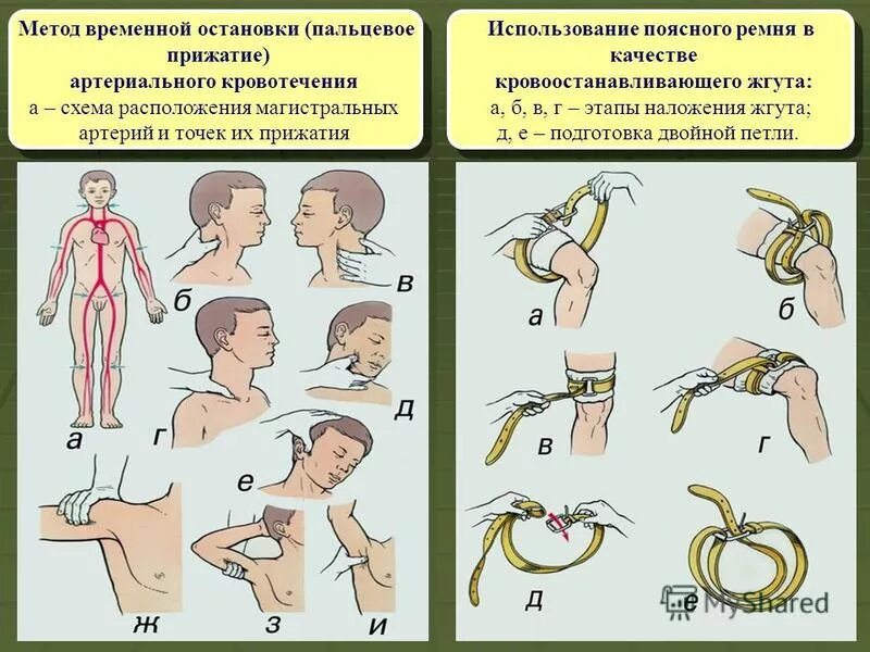 Способы остановки кровотечения пальцевое прижатие артерии