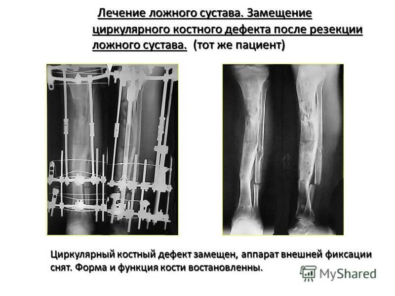 операции при ложных суставах. ложный сустав операция. ложный сустав рентгенодиагностика. ложный сустав операция. ложный сустав операция.