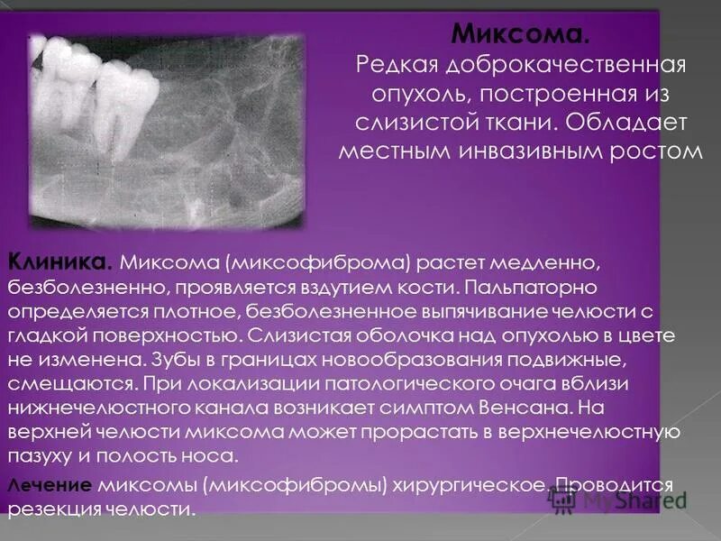 миксома правого предсердия. миксома левого предсердия аускультация. миксома сердца симптомы. миксома. миксома.