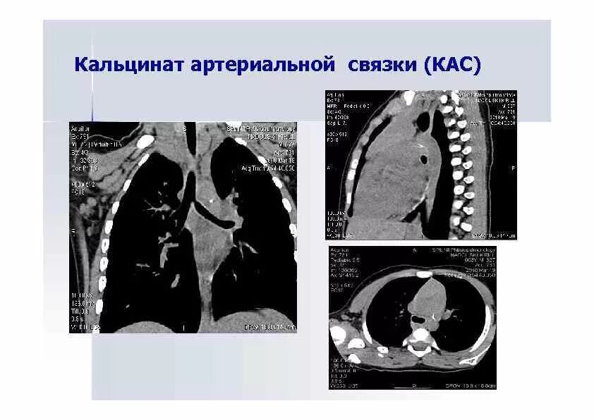 Кальцинированная аортальная связка кт. Обызвествленные лимфоузлы средостения на кт. Кт внутригрудных лимфатических узлов. Кальцинаты средостения кт. Кальцинаты в лимфоузлах