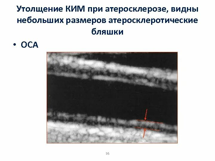 Диффузное утолщение. Что такое утолщение комплекса интима медиа. атеросклеротическая бляшка оса.