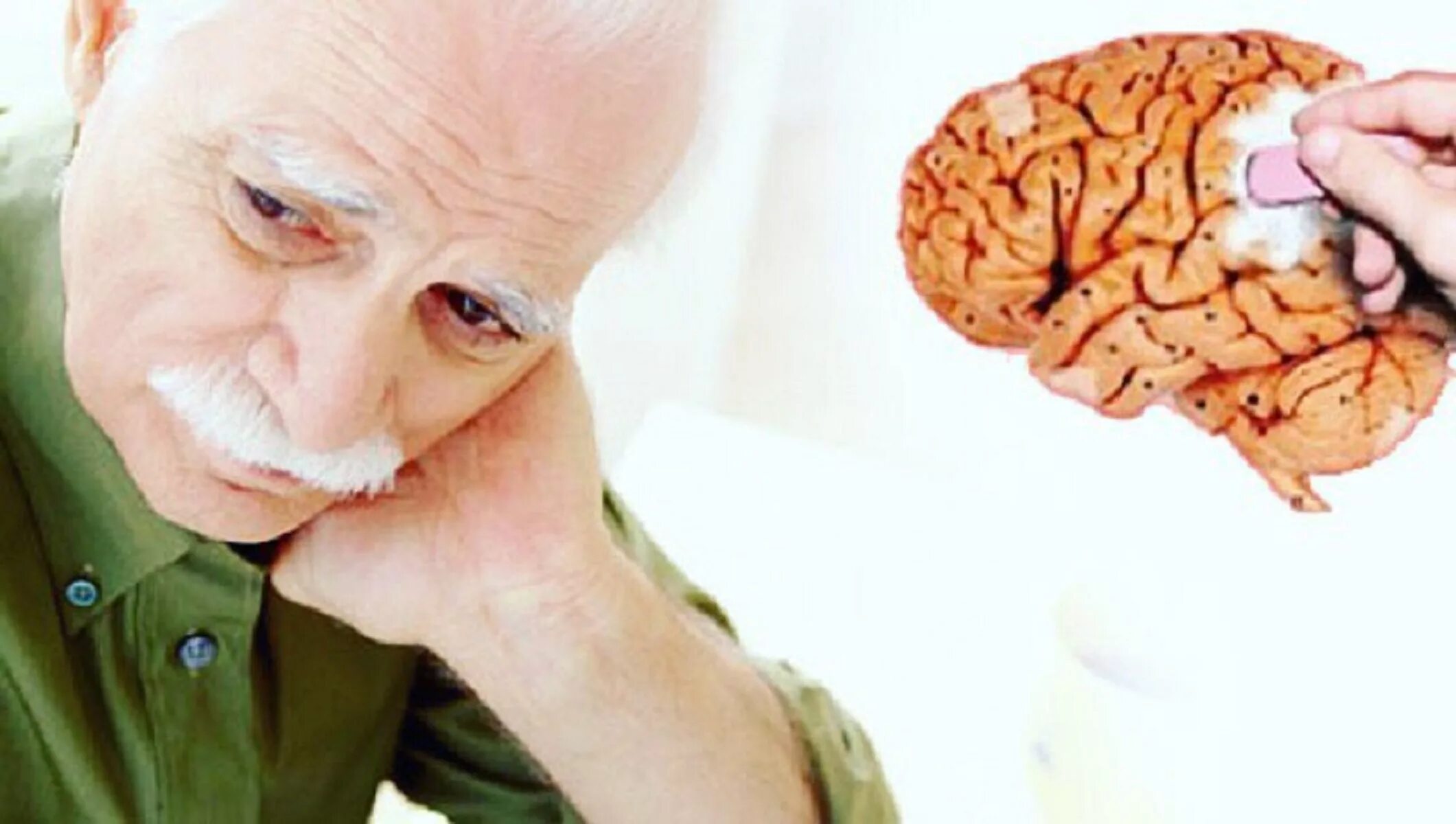 Мозг слабоумие. Хвороба Альцгеймера. Деменция Альцгеймера. Мозг пожилых людей.