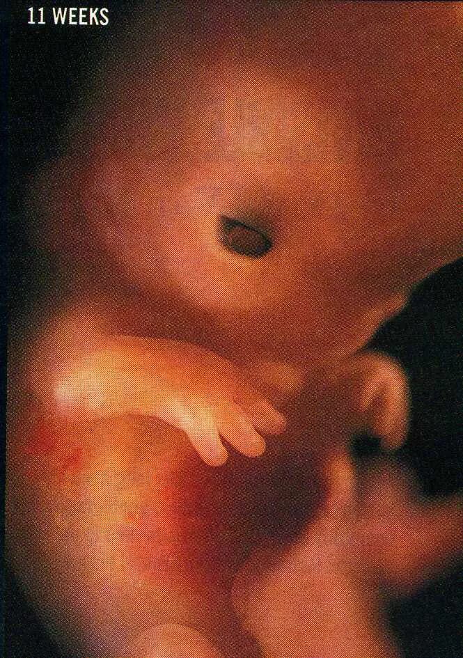 Можно беременность 11 недель. 11 Недель беременности фото плода. Плод на 10 неделе беременности. Эмбрион на 11 неделе беременности.