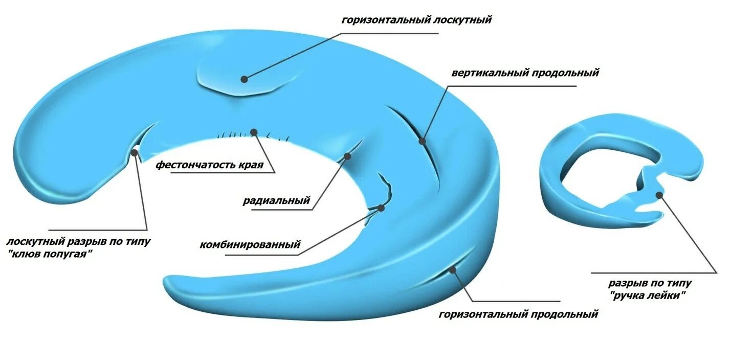 Признаки дегенеративных изменений менисков. Косо горизонтальный разрыв медиального мениска 3 степени. Повреждение заднего рога мениска 3 степени. Разрыв заднего рога медиального мениска 3. Повреждение заднего рога медиального мениска 3 степени по Stoller.