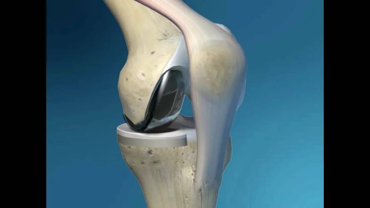 Протез коленного сустава. Материал протеза коленного сустава. Швейцарский протез коленного сустава.