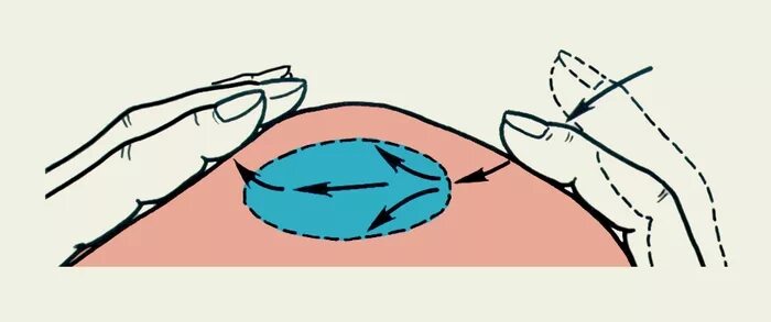 Флуктуация в медицине. Симптом флюктуации при абсцессе. Флюктуация при пальпации. Симптом флюктуации флегмона.