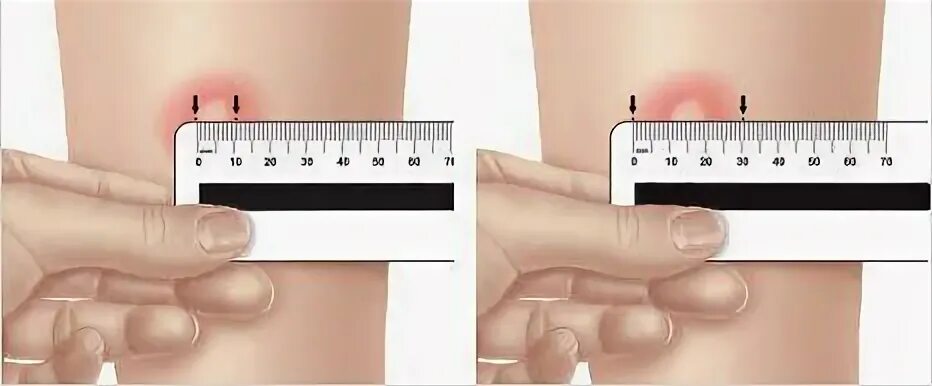 Результаты диаскинтеста у детей норма фото Лекарственный препарат ЗАО "Лекко" Диаскинтест "Д тест или прививка диаскинтес